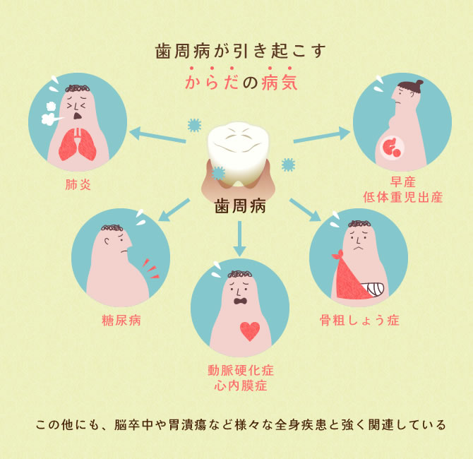 歯周病が引き起こす体の病気 歯周病は脳卒中や胃潰瘍など様々な全身疾患と強く関連している